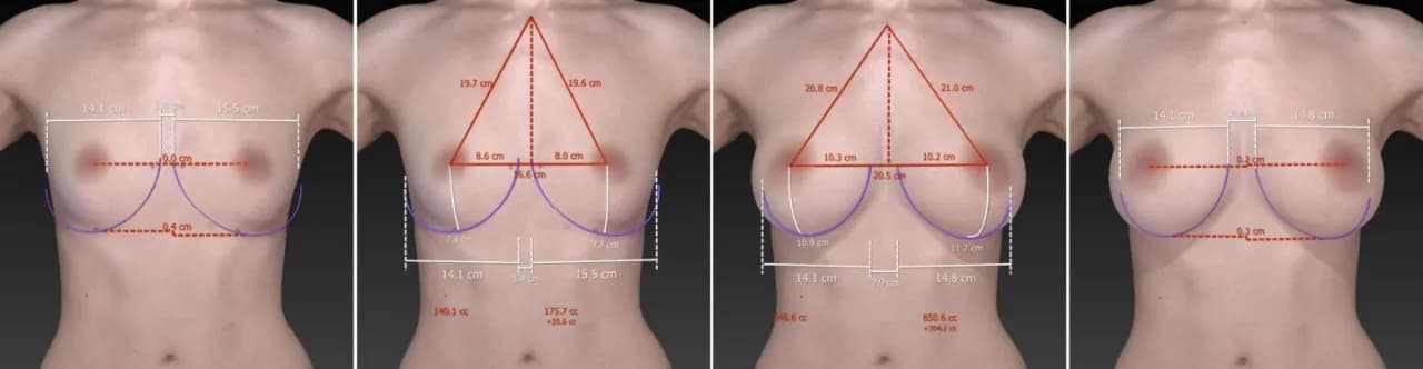 Gdzie najlepiej zrobić operację powiększenia biustu? Ranking klinik