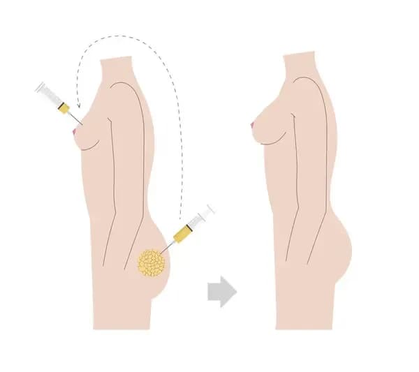 Lipofilling biustu – czy warto? Opinie i doświadczenia kobiet.